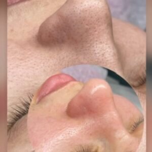 Curso Limpeza de Pele